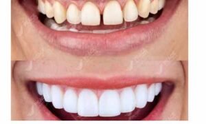 Bọc răng sứ cho 2 răng cửa