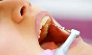 Hình ảnh lấy tủy răng cửa