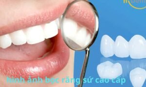 hình ảnh bọc răng sứ cao cấp