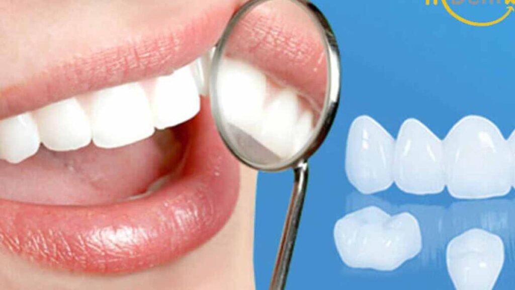 bọc răng sứ titan gia bao nhiêu