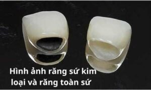hình ảnh răng sứ kim loại và răng toàn sứ