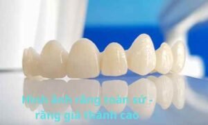 Hình ảnh răng toàn sứ - răng giá thành cao